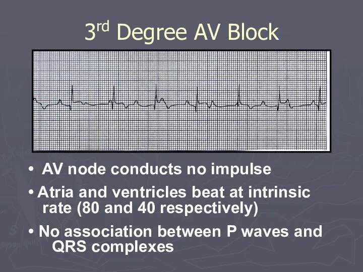AV node conducts no impulse Atria and ventricles beat at