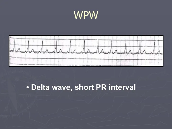 Delta wave, short PR interval WPW