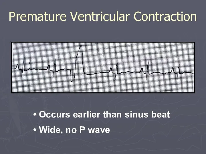 Occurs earlier than sinus beat Wide, no P wave Premature Ventricular Contraction