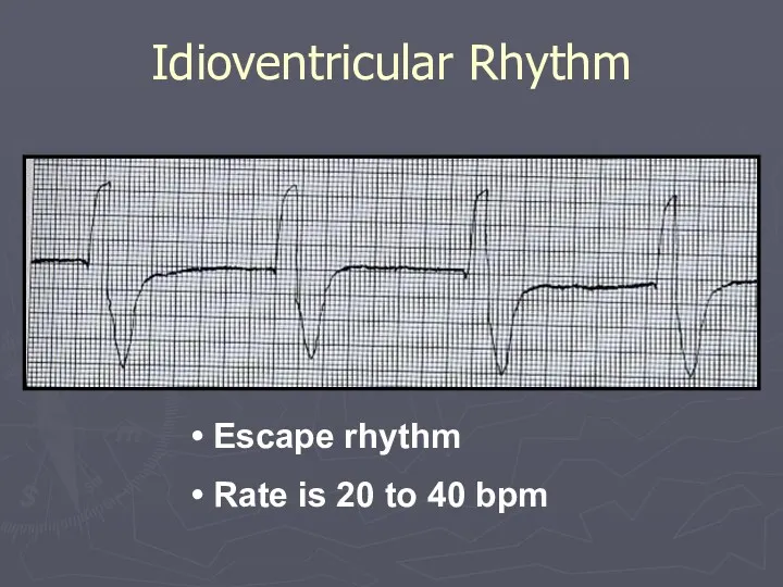 Escape rhythm Rate is 20 to 40 bpm Idioventricular Rhythm