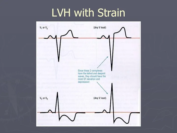 LVH with Strain
