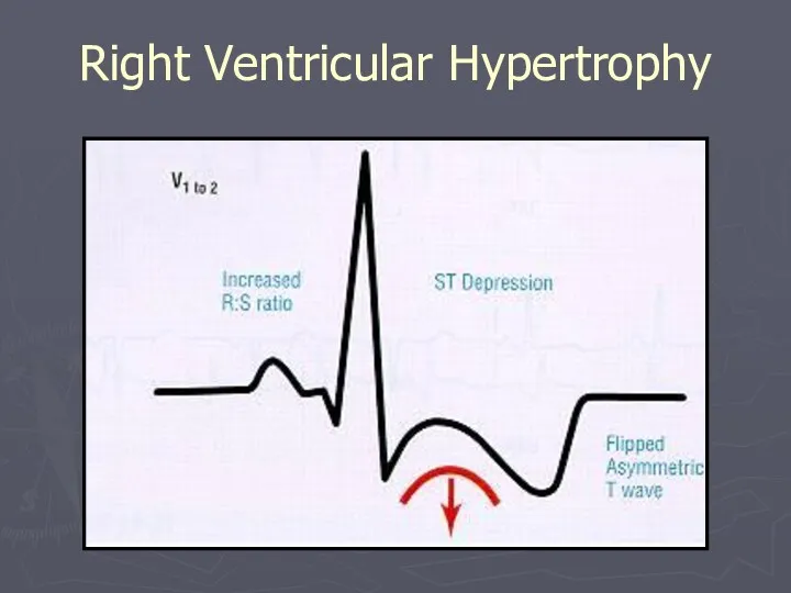 Right Ventricular Hypertrophy