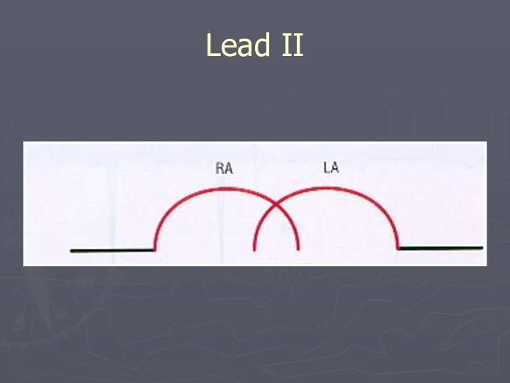 Lead II