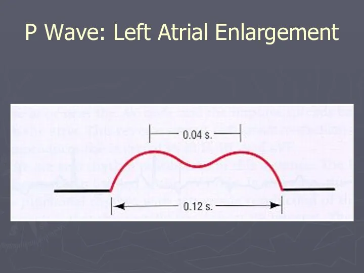 P Wave: Left Atrial Enlargement