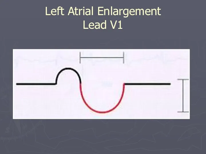Left Atrial Enlargement Lead V1