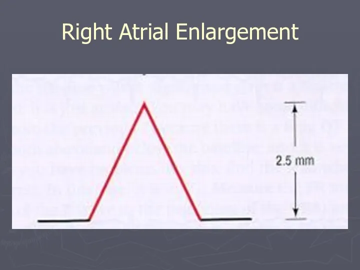 Right Atrial Enlargement