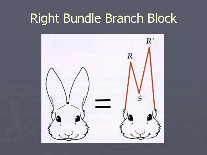 Right Bundle Branch Block