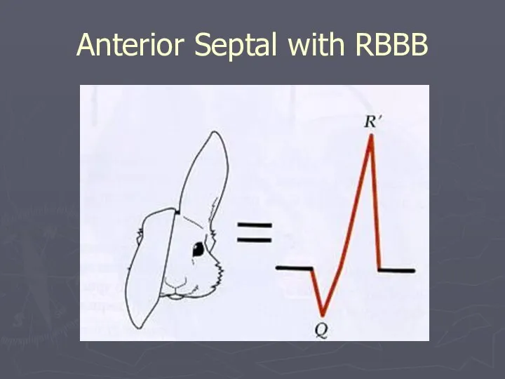 Anterior Septal with RBBB