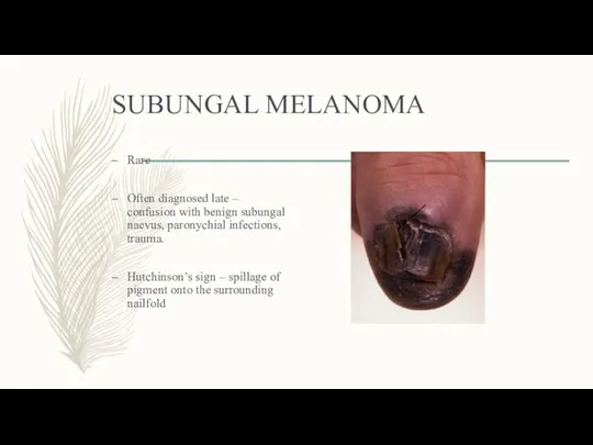 SUBUNGAL MELANOMA Rare Often diagnosed late – confusion with benign subungal naevus, paronychial