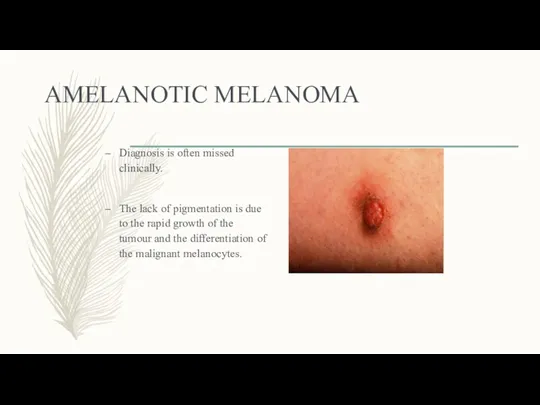 AMELANOTIC MELANOMA Diagnosis is often missed clinically. The lack of pigmentation is due