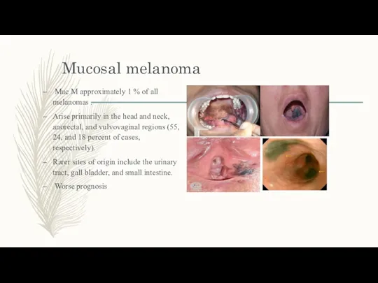 Mucosal melanoma Muc M approximately 1 % of all melanomas . Arise primarily