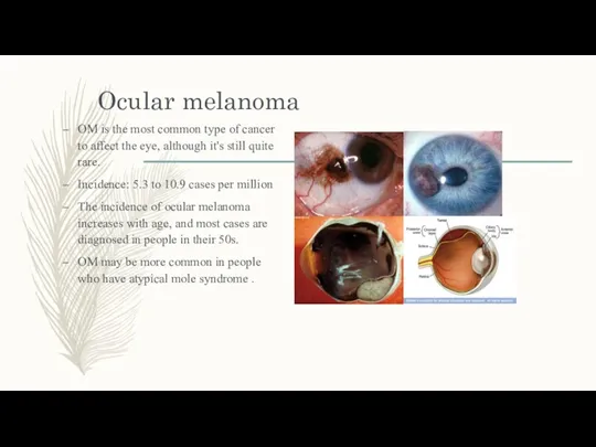 Ocular melanoma OM is the most common type of cancer