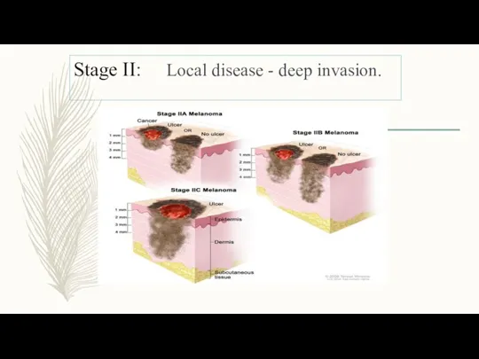 Stage II: Local disease - deep invasion.