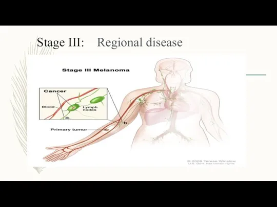 Stage III: Regional disease