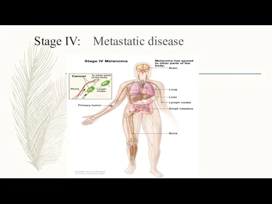 Stage IV: Metastatic disease