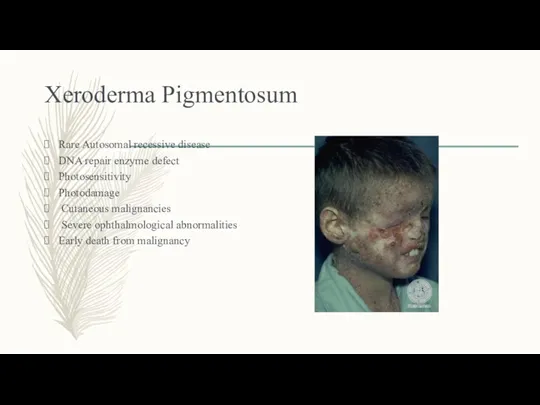 Xeroderma Pigmentosum Rare Autosomal recessive disease DNA repair enzyme defect