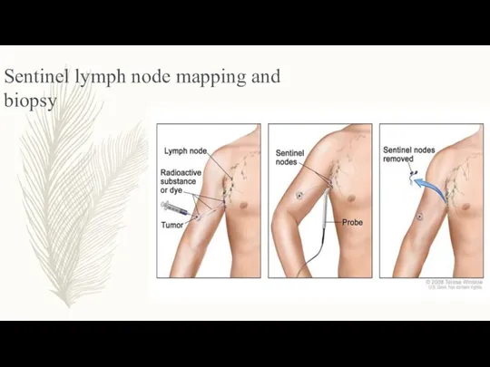 Sentinel lymph node mapping and biopsy