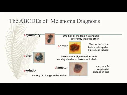 The ABCDEs of Melanoma Diagnosis Asymmetry One half of the lesion is shaped
