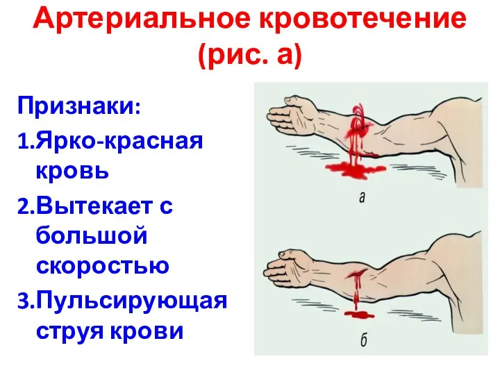 Артериальное кровотечение (рис. а) Признаки: 1.Ярко-красная кровь 2.Вытекает с большой скоростью 3.Пульсирующая струя крови