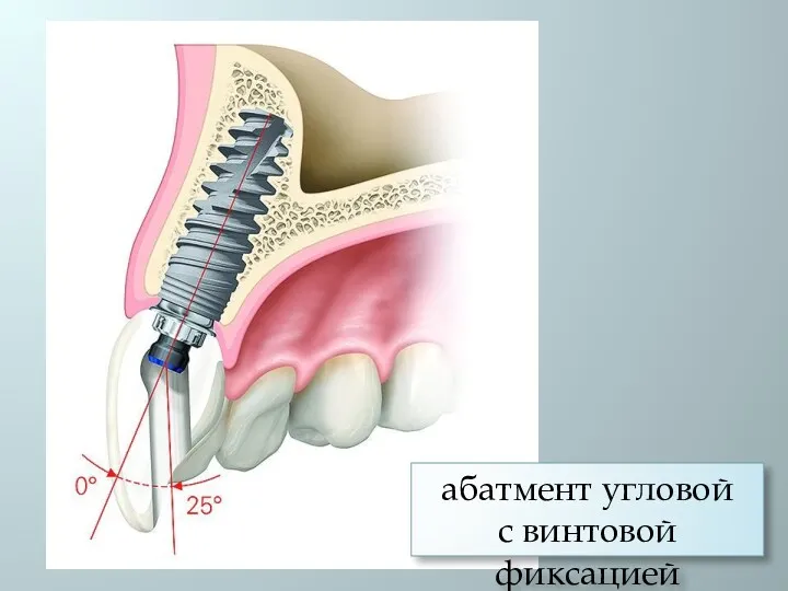 абатмент угловой с винтовой фиксацией