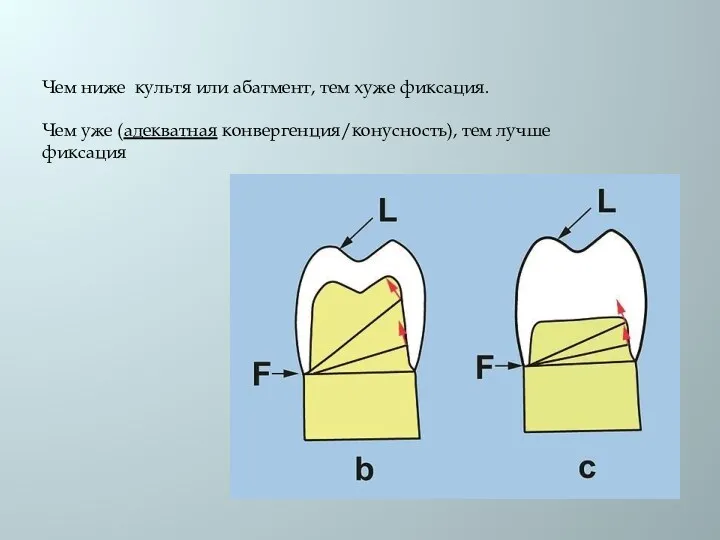 Чем ниже культя или абатмент, тем хуже фиксация. Чем уже (адекватная конвергенция/конусность), тем лучше фиксация