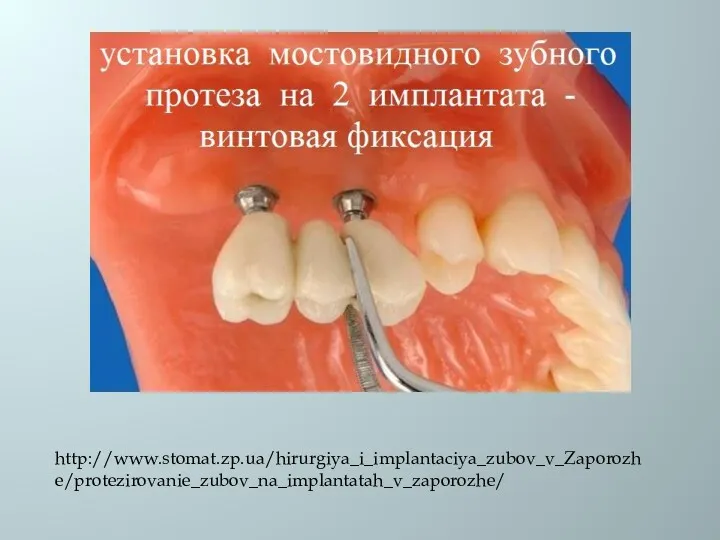 http://www.stomat.zp.ua/hirurgiya_i_implantaciya_zubov_v_Zaporozhe/protezirovanie_zubov_na_implantatah_v_zaporozhe/