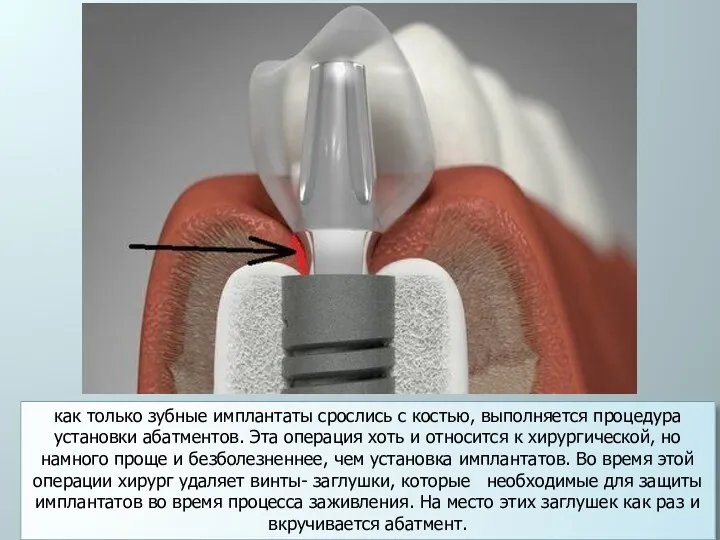 как только зубные имплантаты срослись с костью, выполняется процедура установки