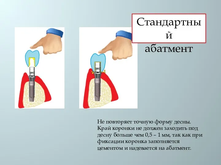 Не повторяет точную форму десны. Край коронки не должен заходить