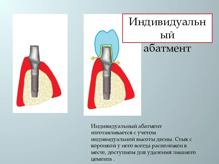 Индивидуальный абатмент изготавливается с учетом индивидуальной высоты десны. Стык с