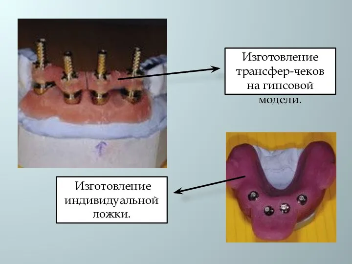 Изготовление трансфер-чеков на гипсовой модели. Изготовление индивидуальной ложки.