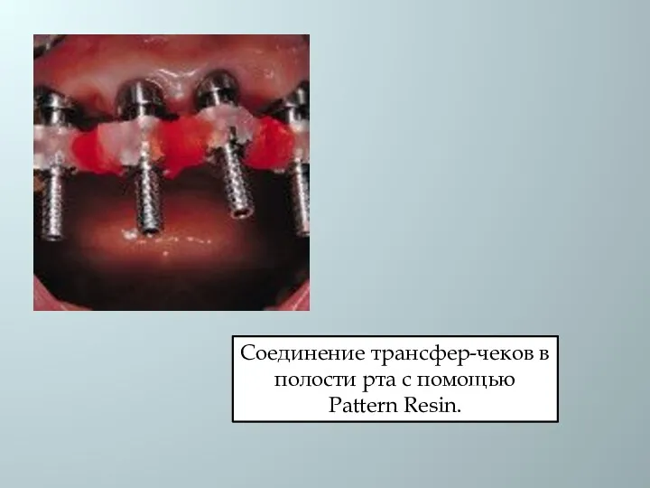 Соединение трансфер-чеков в полости рта с помощью Pattern Resin.