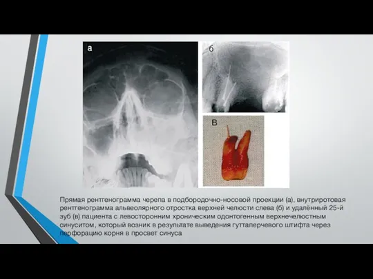 Прямая рентгенограмма черепа в подбородочно-носовой проекции (а), внутриротовая рентгенограмма альвеолярного