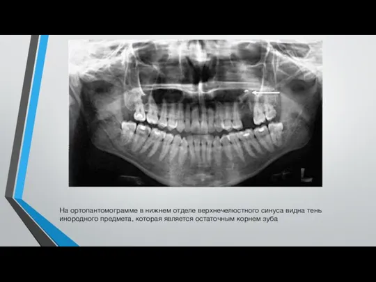 На ортопантомограмме в нижнем отделе верхнечелюстного синуса видна тень инородного предмета, которая является остаточным корнем зуба