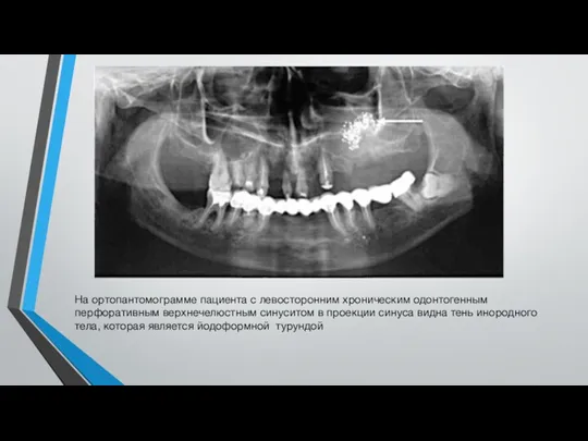 На ортопантомограмме пациента с левосторонним хроническим одонтогенным перфоративным верхнечелюстным синуситом