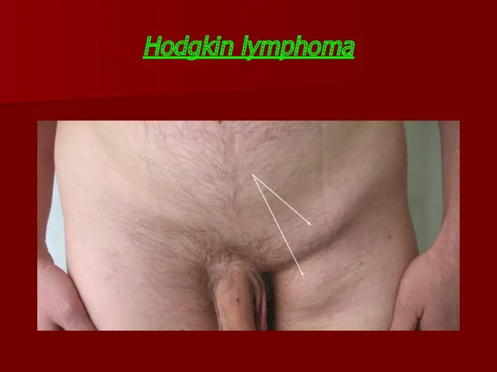 Hodgkin lymphoma
