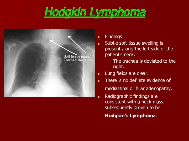 Hodgkin Lymphoma Findings: Subtle soft tissue swelling is present along the left side