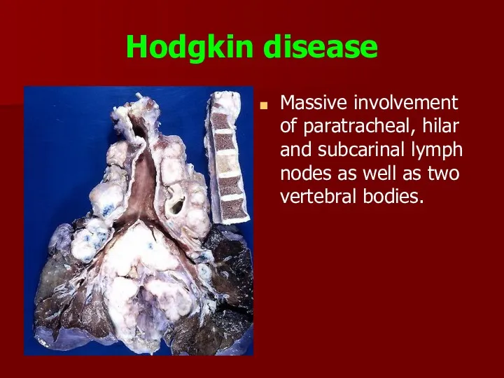 Hodgkin disease Massive involvement of paratracheal, hilar and subcarinal lymph nodes as well