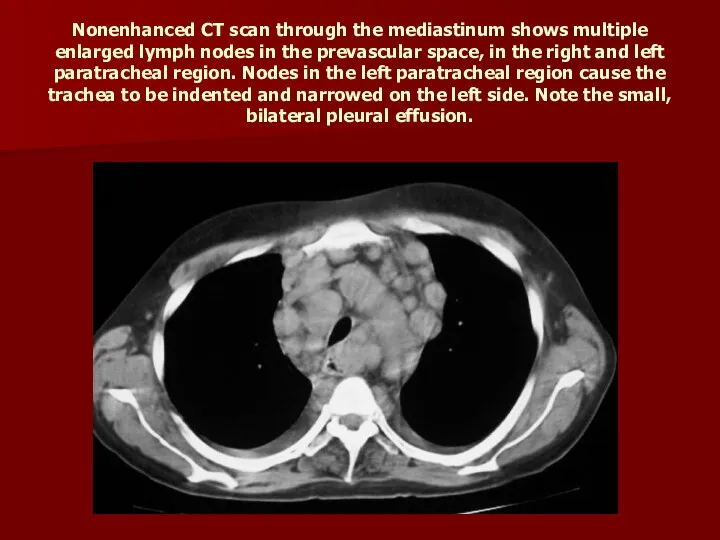 Nonenhanced CT scan through the mediastinum shows multiple enlarged lymph nodes in the