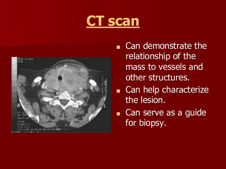 CT scan Can demonstrate the relationship of the mass to vessels and other