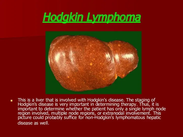 Hodgkin Lymphoma This is a liver that is involved with Hodgkin's disease. The