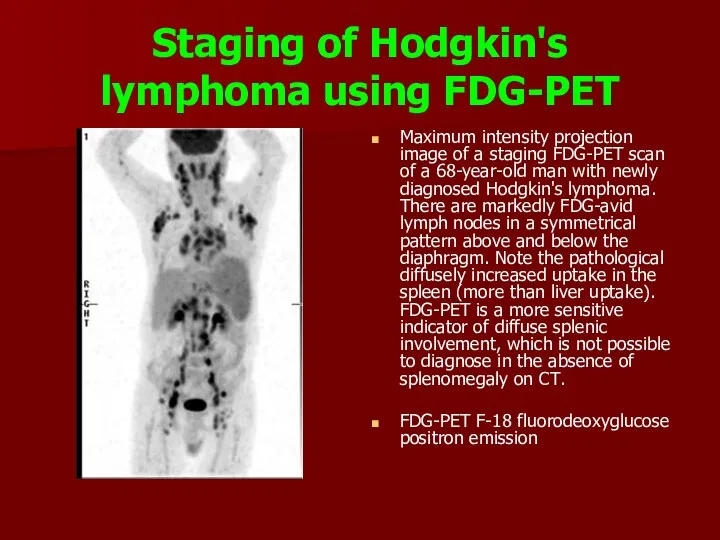 Staging of Hodgkin's lymphoma using FDG-PET Maximum intensity projection image of a staging