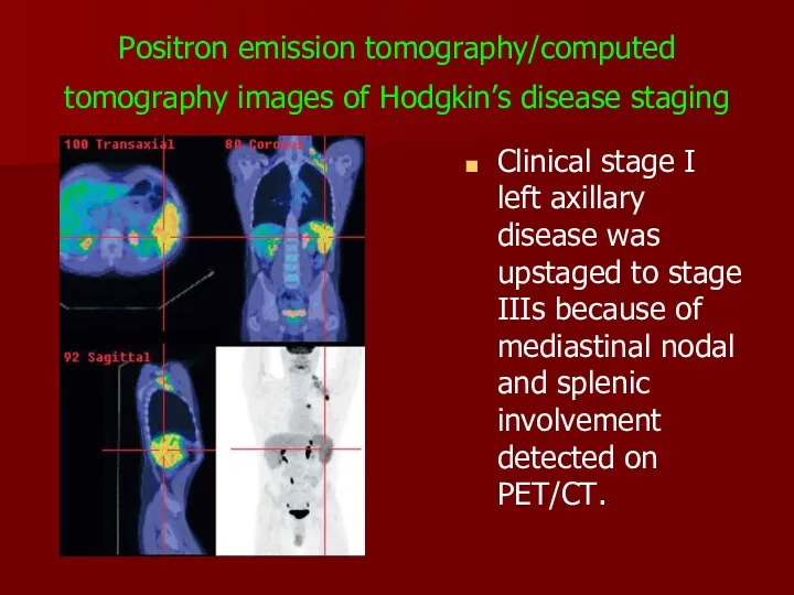 Positron emission tomography/computed tomography images of Hodgkin’s disease staging Clinical stage I left