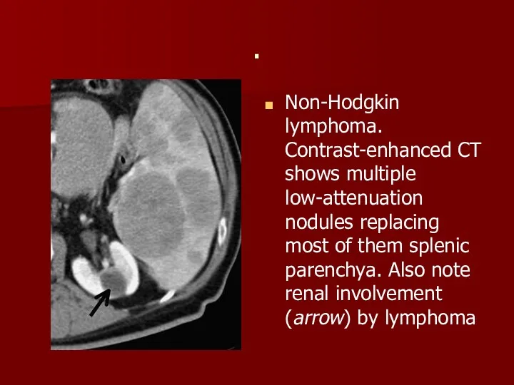 . Non-Hodgkin lymphoma. Contrast-enhanced CT shows multiple low-attenuation nodules replacing most of them