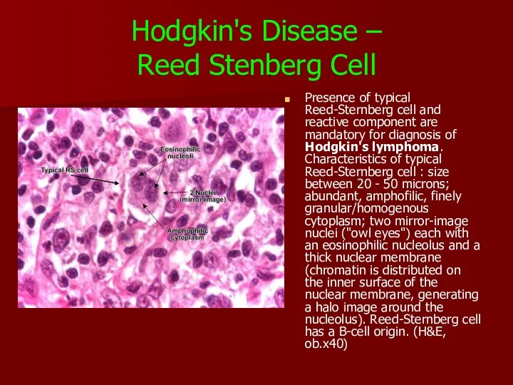 Hodgkin's Disease – Reed Stenberg Cell Presence of typical Reed-Sternberg cell and reactive