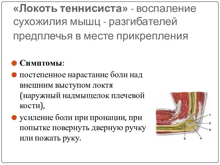 «Локоть теннисиста» - воспаление сухожилия мышц - разгибателей предплечья в