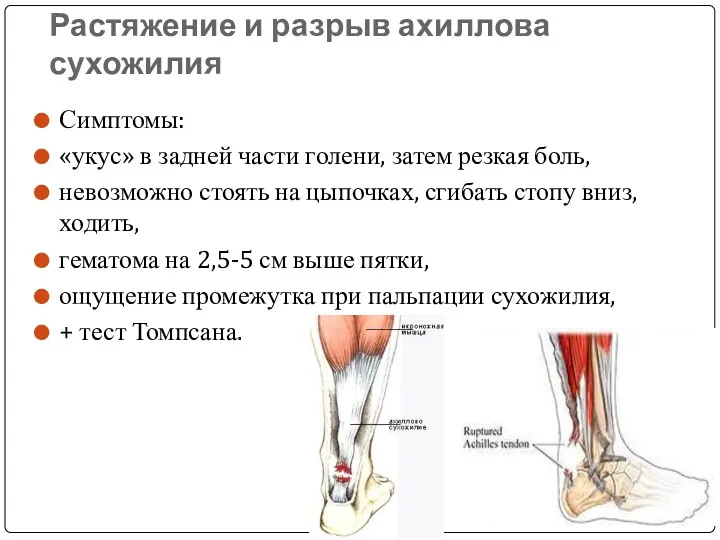 Растяжение и разрыв ахиллова сухожилия Симптомы: «укус» в задней части
