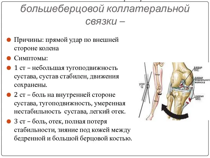 Растяжение и разрыв большеберцовой коллатеральной связки – Причины: прямой удар