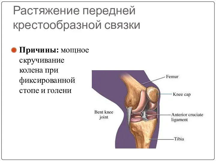 Растяжение передней крестообразной связки Причины: мощное скручивание колена при фиксированной стопе и голени