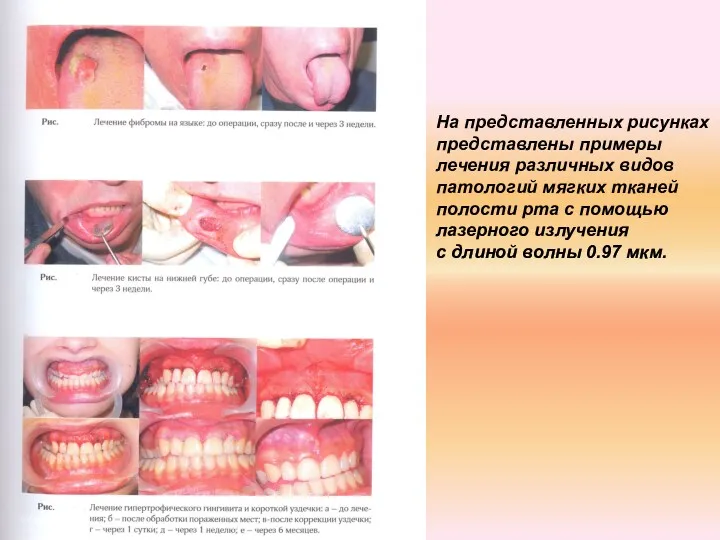 На представленных рисунках представлены примеры лечения различных видов патологий мягких тканей полости рта