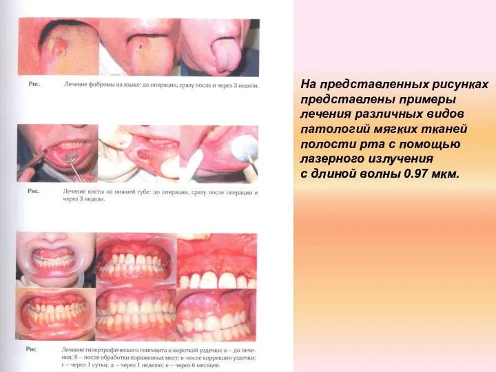 На представленных рисунках представлены примеры лечения различных видов патологий мягких